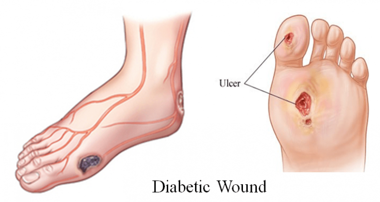 Healing Diabetic Wounds with HOCl – HOCl Health Care